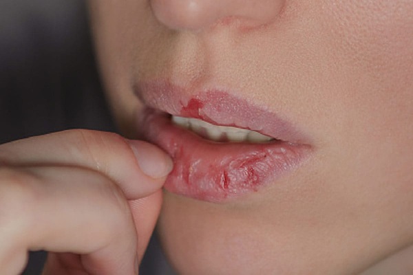 होंठों की रूखापन से परेशान हैं? ये हो सकता है कारण होंठों